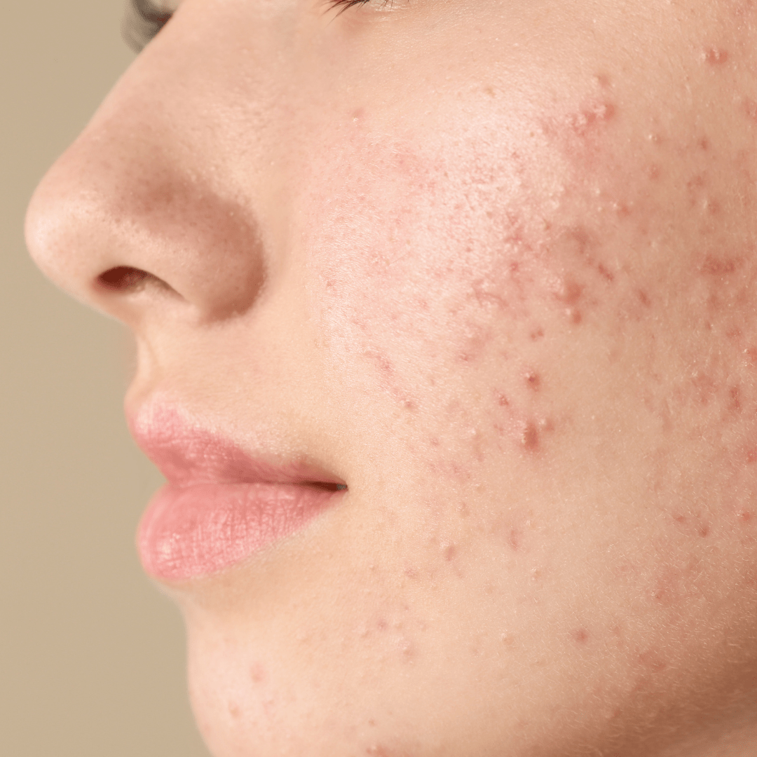 Is Acne Medication Healing Your Skin – Or Hiding the Root Cause? - Kayle at Home
